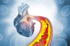 Ilustração 3-D de um coração humano com uma corrente sanguínea bloqueada contra um fundo azul com plaquetas sanguíneas indicadas