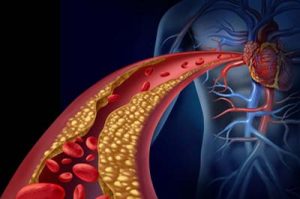 Ilustração 3-D de um coração humano com a corrente sanguínea entupida contra um fundo azul