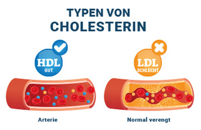 Grafische Darstellung der zwei Typen von Cholesterin