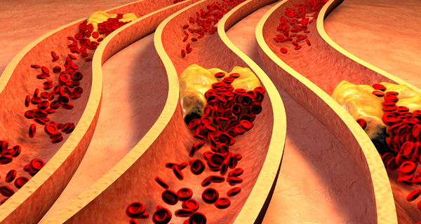 Medizinische 3D-Illustration von verstopften Arterien