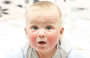 Primo piano del viso di un bambino con chiari segni di neurodermite