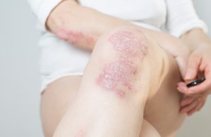 Close up of woman with psoriasis on knee and elbow
