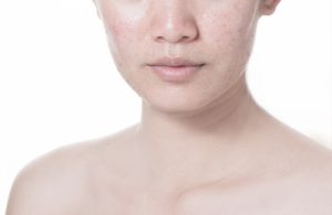Primer plano de la cara de una mujer joven con pústulas de acné