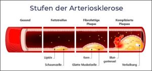 Graphical representation of the different stages of arteriosclerosis.