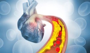 Ilustración en 3D del corazón humano, en primer plano puede verse una arteria ya obstruida que conduce al corazón.