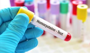 Gros plan sur un échantillon de sang testé pour l'homocystéine. L'échantillon est examiné au laboratoire par une personne portant des gants en caoutchouc.