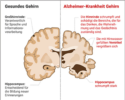 Illustration gesundes Gehirn versus Gehirn mit Alzheimer