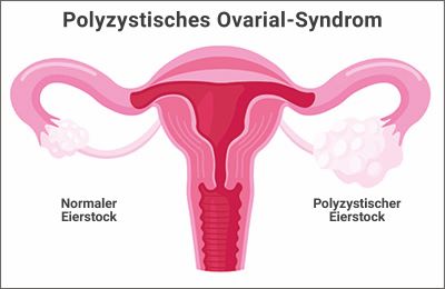 Illustration Polyzystisches Ovarial-Syndrom