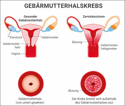 Illustration Gebärmutterhalskrebs