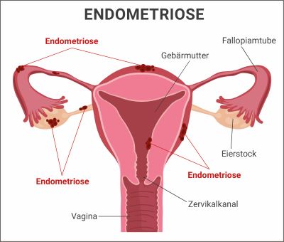 Illustration Endometriose
