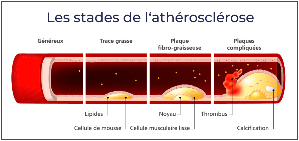 Représentation graphique des différents stades de l'artériosclérose