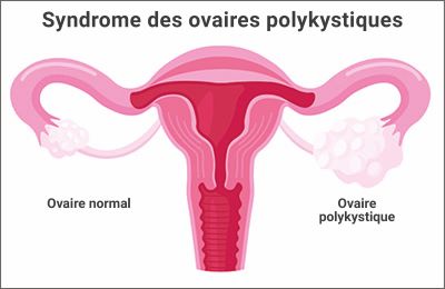 Illustration du syndrome des ovaires polykystiques