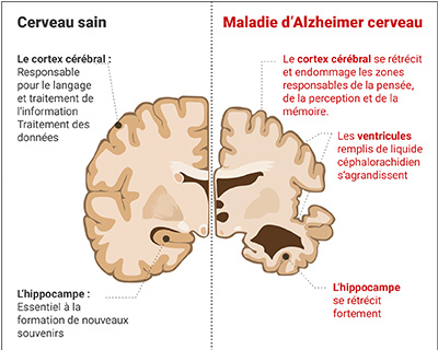 Illustration cerveau sain versus cerveau atteint de la maladie d'Alzheimer