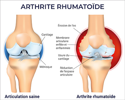 Illustration Rheumatische Arthritis