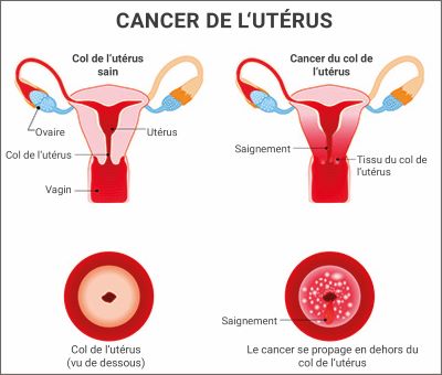 Illustration du cancer du col de l'utérus