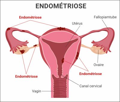 Illustration de l'endométriose