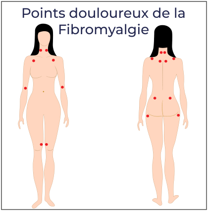 Frafische Darstellung der Schmerzpunkte bei Fibromyalgie