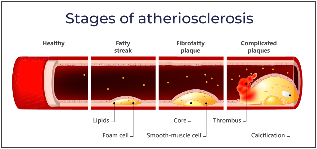 Graphic representation of the different stages of arteriosclerosis