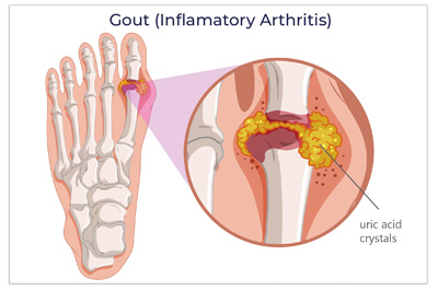 Graphic representation of the development of gout and uric acid crystals