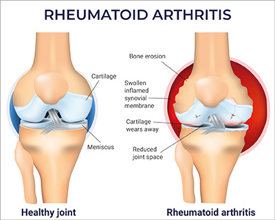 Illustration Rheumatoid arthritis