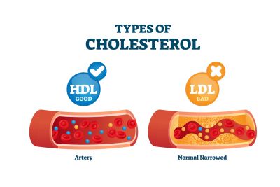 Graphical representation of the two types of cholesterol