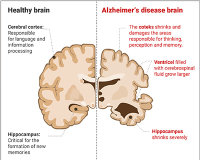 Illustration of healthy brain versus brain with Alzheimer's disease