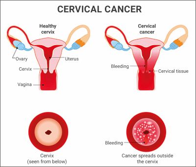 Illustration of cervical cancer