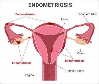 Illustration endometriosis
