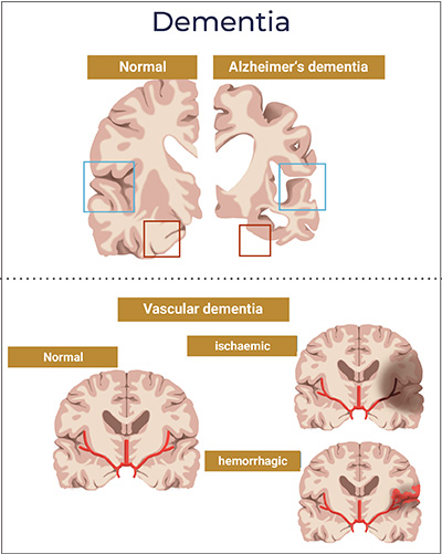 Illustration of Alzheimer's dementia and vascular dementia